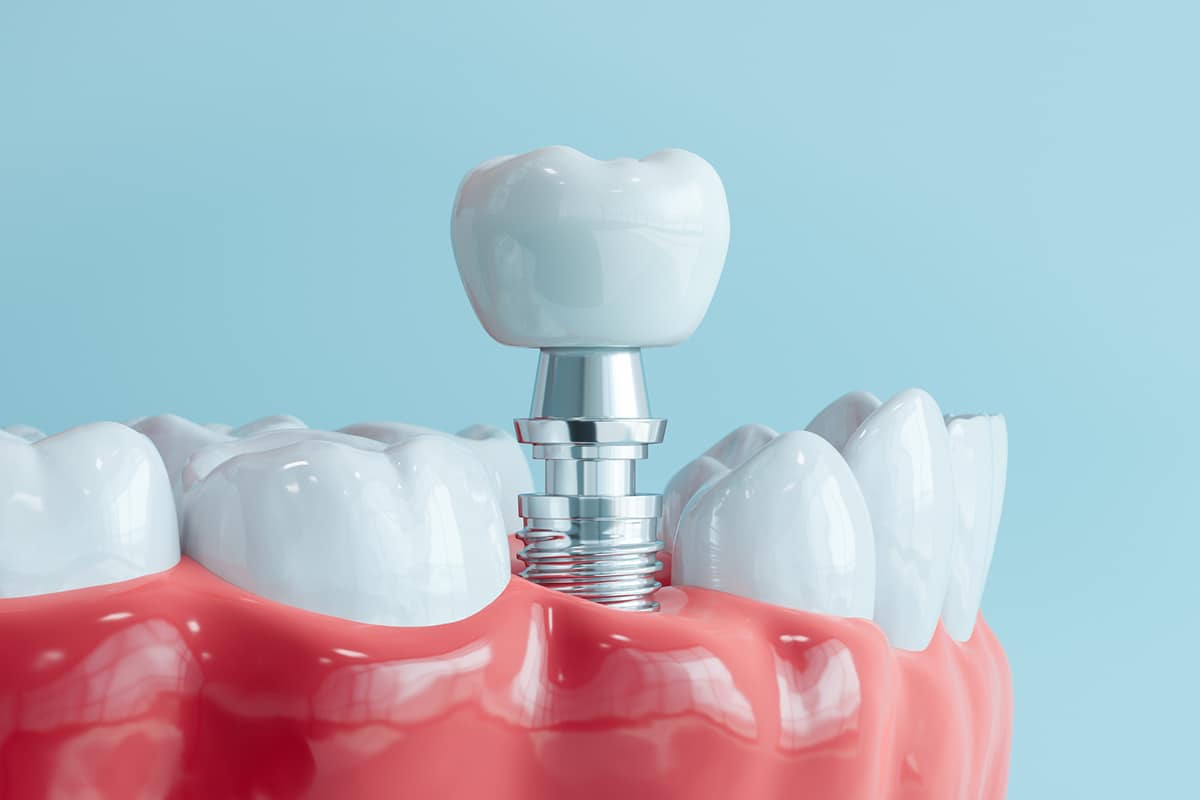 What to expect during oral surgery for dental implant placement blog